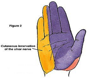 Carpal Tunnel Syndrome - figure 2