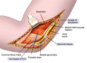 Carpal Tunnel Syndrome - figure 3